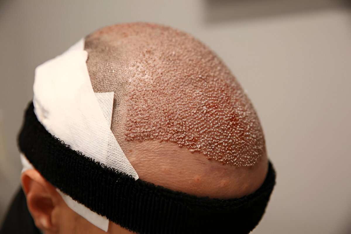 Hair Transplant