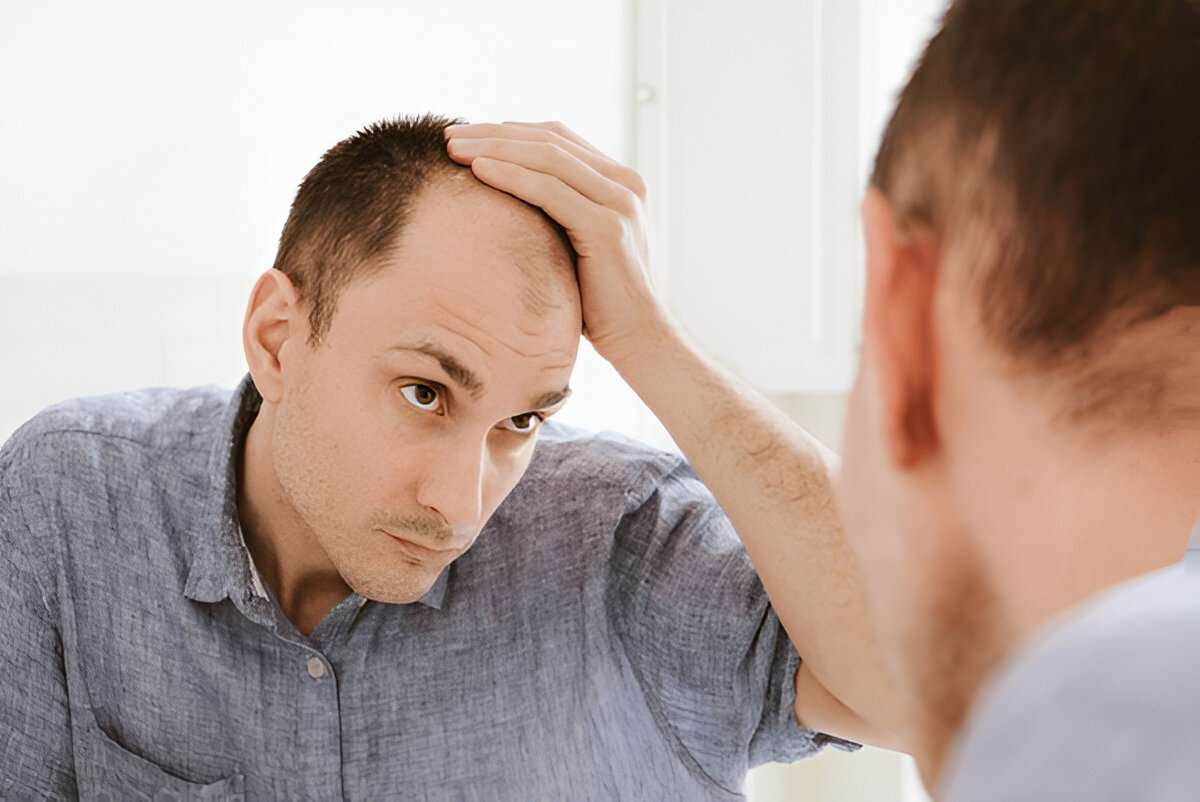 What a Bad Hair Transplant Looks Like And How to Avoid One