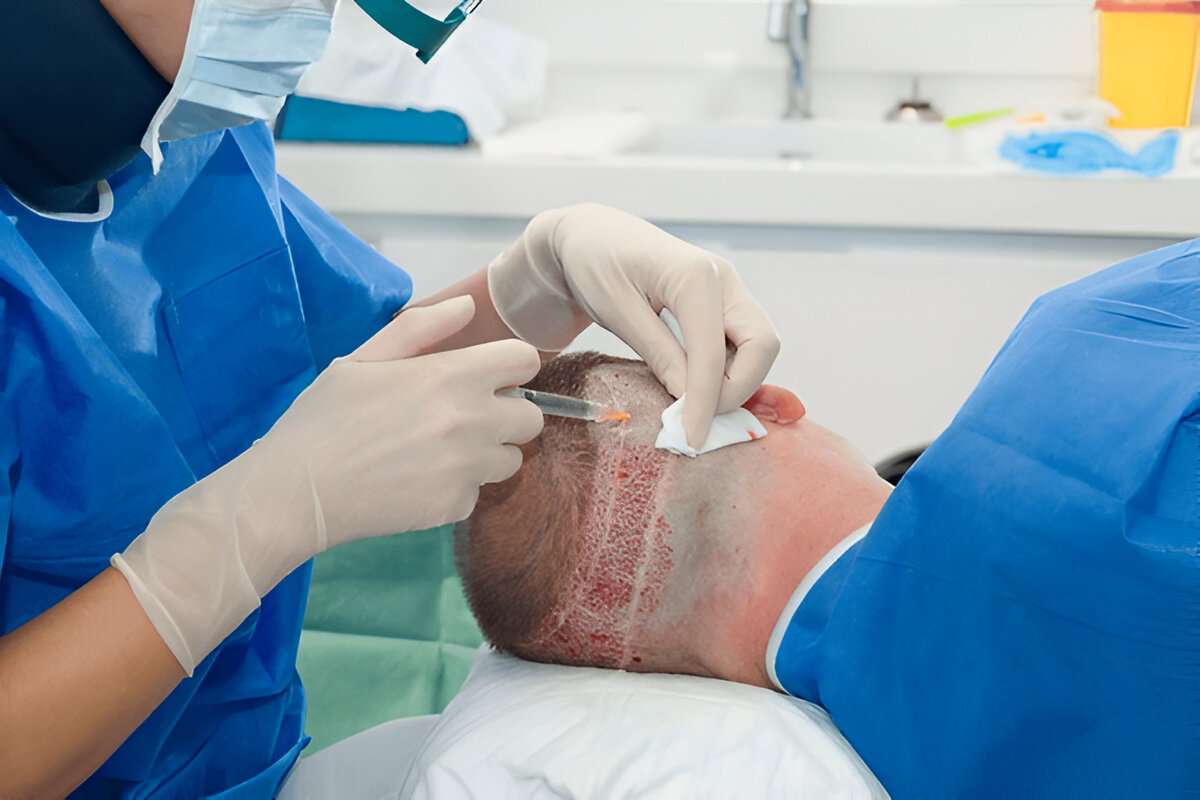 Hair transplant Bristol